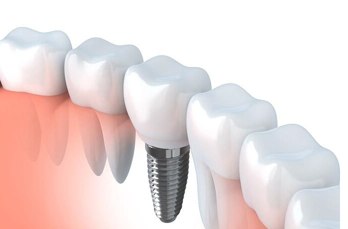 预计8千一颗“3D打印牙” 你会做吗？