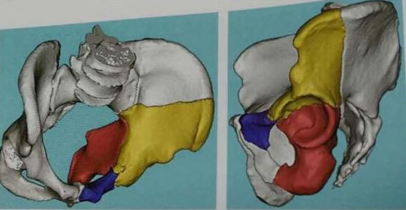 3D打印技术在骨盆骨折的应用