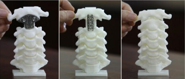 3D打印重建颈椎运动功能 新技术给金属材料“做按摩”