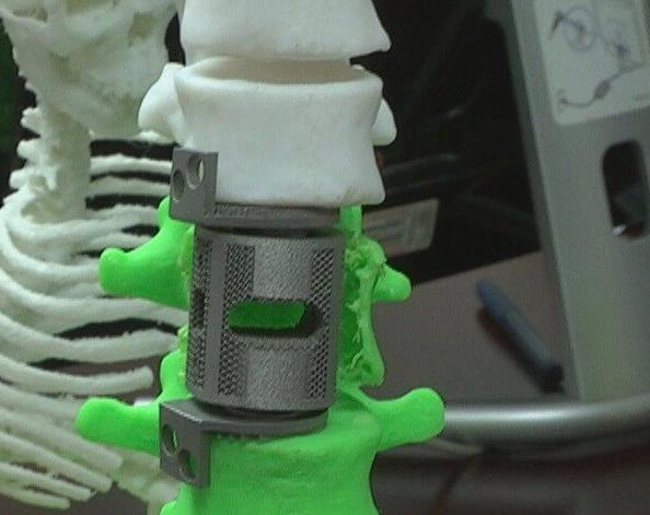 世界领先  西安交大3D打印重建脊柱脊髓