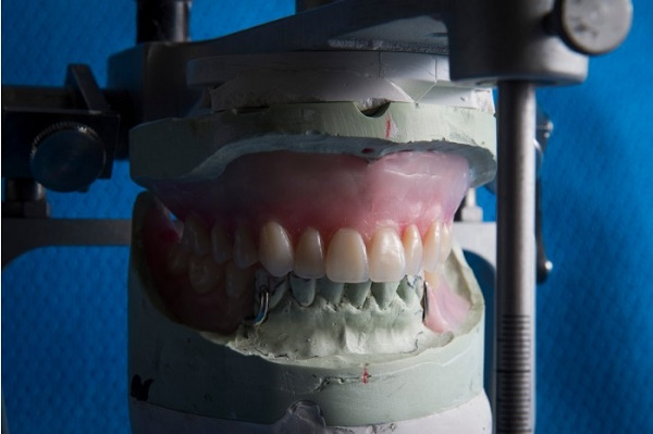 3D打印假牙